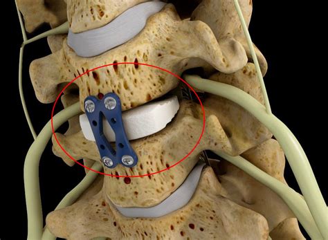 Anterior Cervical Discectomy And Fusion Acdf Surgery Cost India My