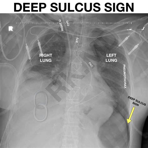Deep Sulcus Sign Rkmd