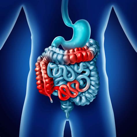 Crohn Disease Update On Diagnosis Pathophysiology And Treatment