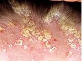 Photos of Scalp Psoriasis And Keratin Treatment