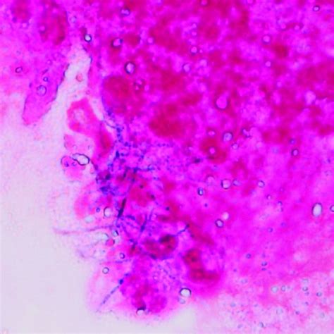 Gram Staining Of The Secretion From The Cavity Shows Gram Positive Rods