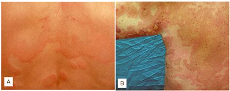 Clinical Pictures Of Chronic Urticaria And Bullous Pemphigoid Wheals