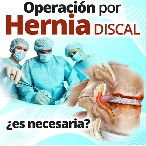 Operación Por Hernia Discal ¿es Necesaria Cordus