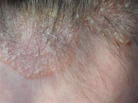 Scalp Psoriasis What Dermatologists Wish You Knew Best Health