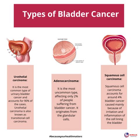 Types Of Bladder Cancer Niruja Healthtech