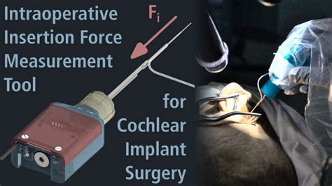 Slow Insertion Of Cochlear Implant Electrodes