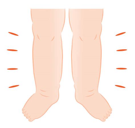 1 000 leg swelling stock illustrations royalty free vector graphics and clip art istock