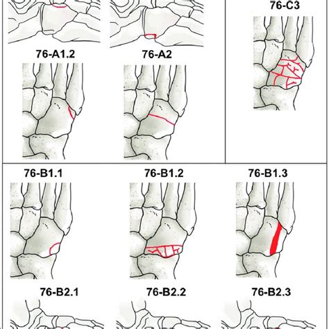 Orthopaedic Trauma Association Classification Of Cuboid Fractures