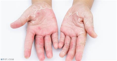 أمراض الجلد الفطرية أعراضها وطرق علاجها بالتفصيل