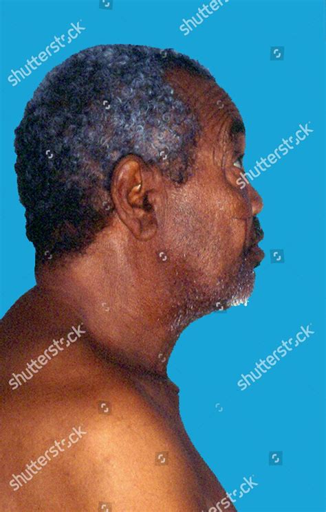 Patient Has Multinodular Goitre Swelling Neck Editorial Stock Photo