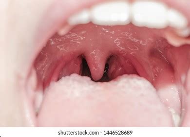 Larynx Images, Stock Photos & Vectors | Shutterstock