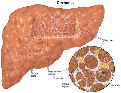 Cirrhosis Of The Liver Symptoms Diagnosis Survival Rate And Treatment