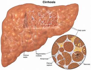 Cirrhosis of the liver - Symptoms, Diagnosis, Survival Rate and Treatment Cirrhosis  
