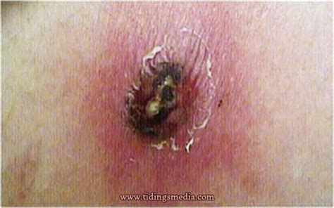 Brown Recluse Spider Symptoms Hot Sex Picture
