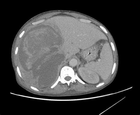 Rt Liver Abscess Pet Ct Radiology Gastroenterology