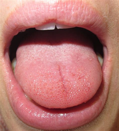 Floor Of Mouth Swelling On One Side Review Home Decor