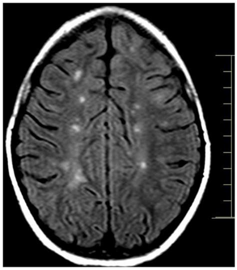 Brain Mri Showing Multiple Juxtacortical Lesions Open I Free Download Nude Photo Gallery