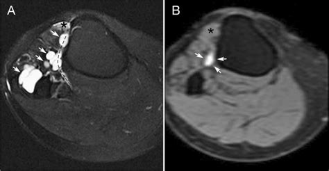 A Case Of “spontaneous Regression Of Cyst Volume” In Intraneural
