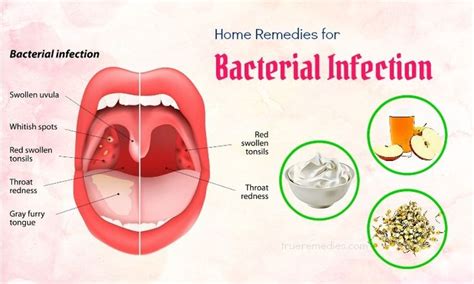 10 Best Home Remedies For Bacterial Infection In Throat Bacterial