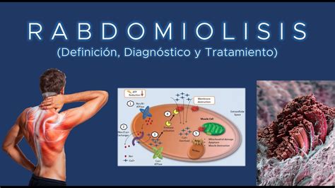 Rabdomiolisis Definición Diagnóstico Y Tratamiento Youtube