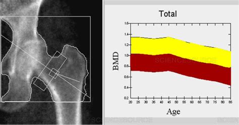 9 Benefits Of A Dexa Bone Density Scan