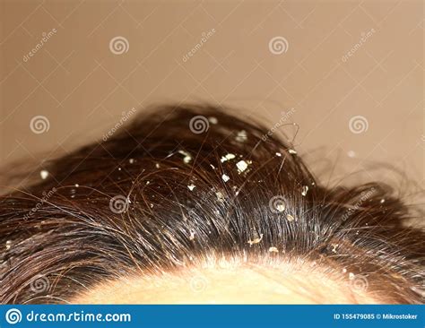 Dandruff On The Hair. Hair Disease Seborrhea. Fatty Dandruff. Stock ...