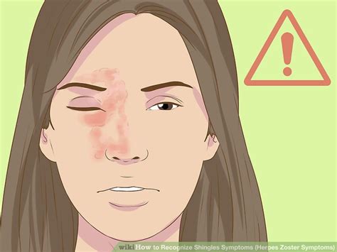 After your chickenpox are gone, the varicella virus stays in your body as an inactive virus. 4 Ways to Recognize Shingles Symptoms (Herpes Zoster Symptoms)