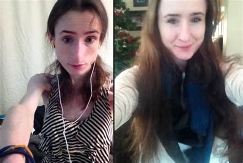 Brave Anorexia Survivor Posts Shocking Recovery Photos On Weight Loss Thread