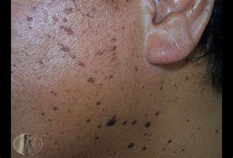 Lesions On Skin Of Color What You Need To Know