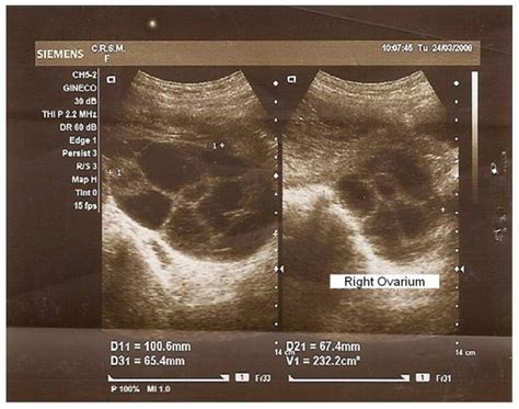 Ultrasound Aspect Of The Right Ovary With 232 Cc Showing Large Theca