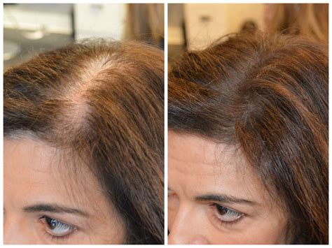 Coverage Of Roots And Thinning New Product Therapy Hair Studio