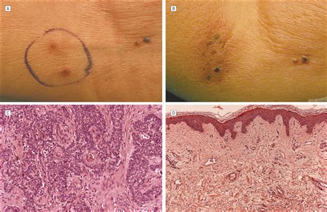 Metastatic Basal Cell Carcinoma With Squamous Differentiation Report