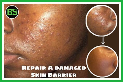 How To Repair A Damaged Skin Barrier The Comprehensive Guide