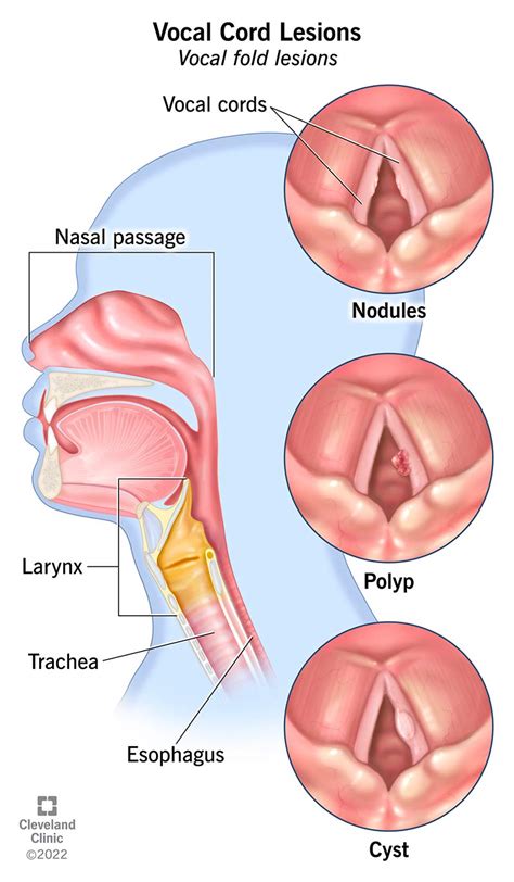 Vocal Cord Nodules Causes Symptoms And Treatment
