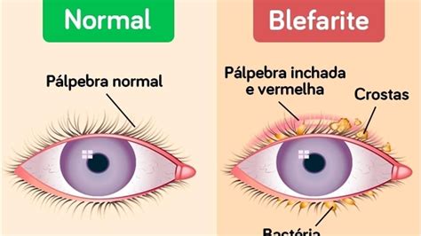 Pálpebras Inchadas O Que Pode Ser