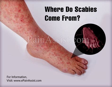 Where Do Scabies Come From And Where Does Scabies Start On