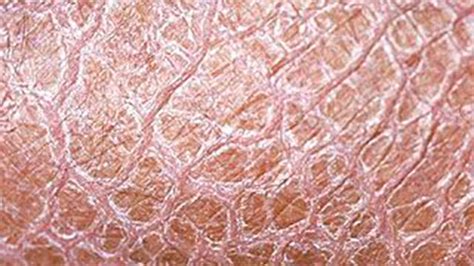 Ichthyosis Vulgaris Causes Symptoms And Diagnosis