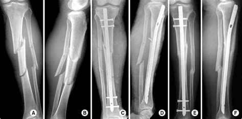 A B Preoperative Radiographs Of A 56 Year Old Man Show A Tibia