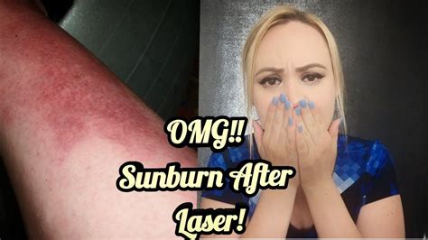 Sun Exposure After Laser Hair Removal 2018 W PICTURES YouTube