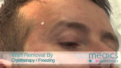 facial wart removal by freezing with liquid nitogen at wart clinic youtube