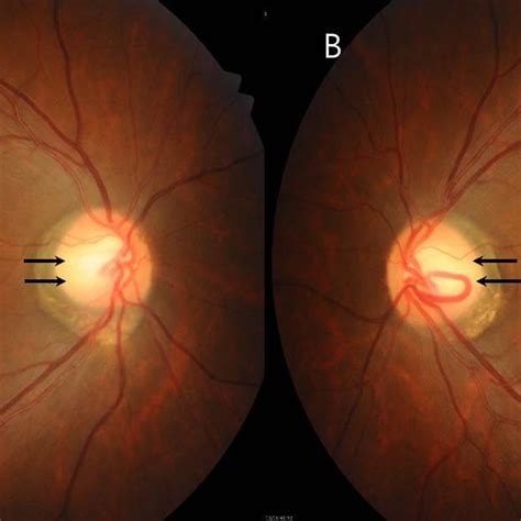 Bilateral Mild Optic Disc Pallor Of The Temporal Sides Arrows In