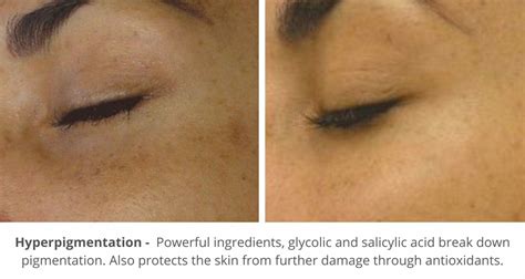 Hydrafacial Before And After Photos London Premier Laser And Skin Clinic