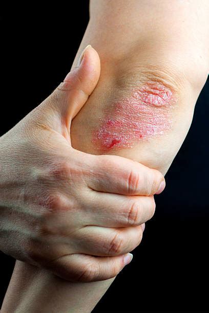 Plaque Psoriasis Elbow Stock Photos Pictures And Royalty Free Images