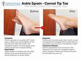 How To Speed Up Ankle Sprain Recovery Photos