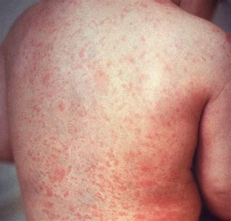 Measles And Rubella Symptoms Similarities And Differences