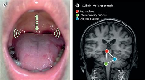 Chronic Clicking Tinnitus Due To Palatal Tremor Essential Or Secondary