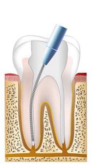 root canal therapy charming smiles  la quinta