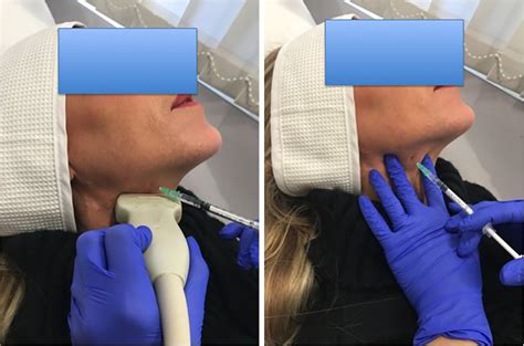 Demonstration Of Two Different Submandibular Gland Injection Techniques