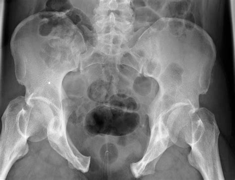 Pelvic Fracture X Ray Photograph By Du Cane Medical Imaging Ltd