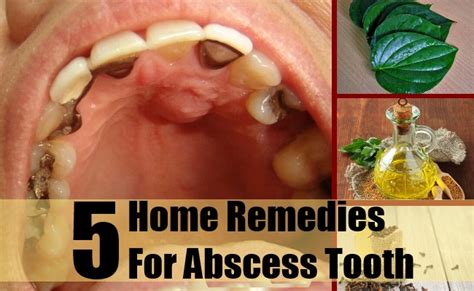 5 Home Remedies For Abscess Tooth Natural Home Remedies And Supplements